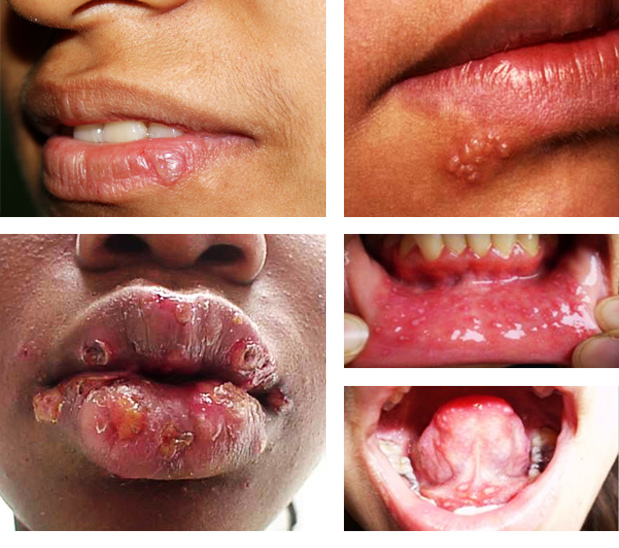 Herpes en otras partes del cuerpo