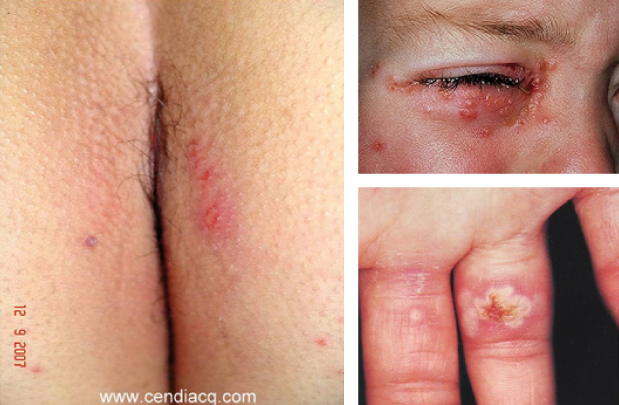 Herpes en otras partes del cuerpo